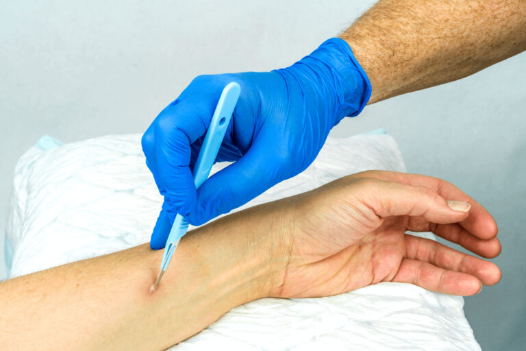 Why Do I Keep Getting Abscesses? : Causes and Prevention